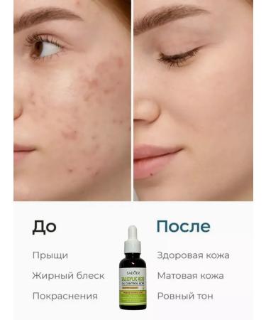 Facial serum from acne and black points of comedones acne - Buy Online on GoSupps.com