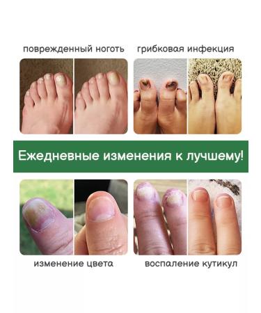 100% Original Nail fungus agent 30 g - Buy Online on GoSupps.com