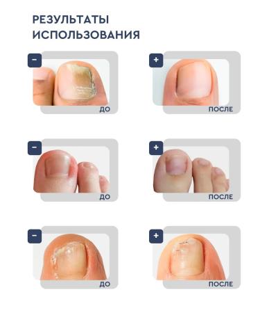 INKI Softener for the treatment of ingrown nails on the legs and arms 100 - Buy Online on GoSupps.com