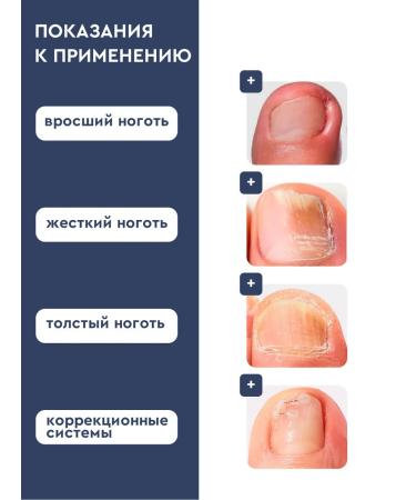 INKI Softener from ingrown nails on the legs and arms 100 ml - Buy Online on GoSupps.com