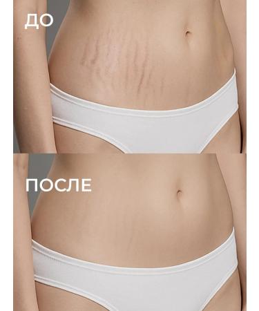Imopherase From stretch marks from scars for pregnant women and adolescents - Buy Online on GoSupps.com