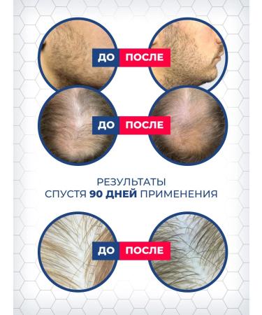 KOPEXIDIL Hair growth 3-in-1 kopexidal - Buy Online on GoSupps.com