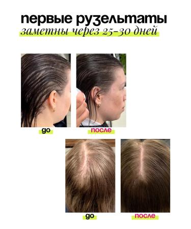 Sointera Piling for scalp with acids for hair growth - Buy Online on GoSupps.com