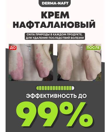 DERMANAFT Cream from psoriasis of atopic dermatitis of eczema neurodermatitis - Buy Online on GoSupps.com