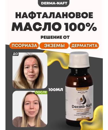 DERMANAFT Oil from psoriasis and seborrhea naphthalan