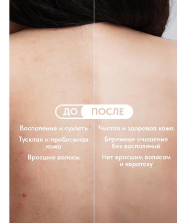 EDEN Body cream with acids from acne 150 ml - Buy Online on GoSupps.com