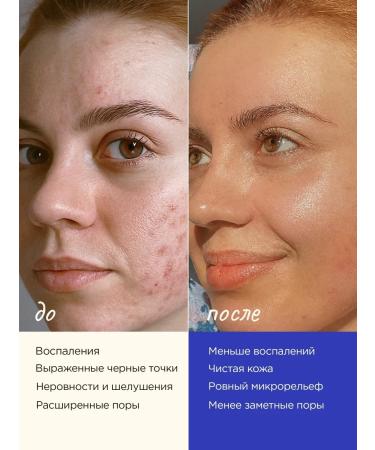 VOIS A set of facial serum with salicylic acid from acne - Buy Online on GoSupps.com