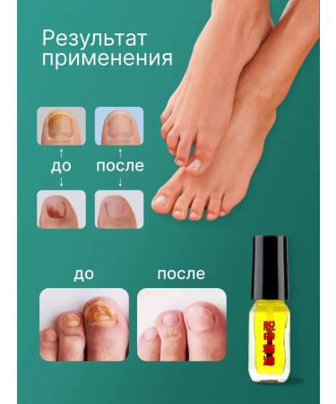 Knapweed Antifungal oil for nails 2 pcs - Buy Online on GoSupps.com