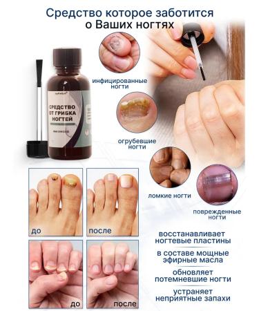 JoyPrettyin Remedy for nail fungus on the legs of the arms treatment - Buy Online on GoSupps.com