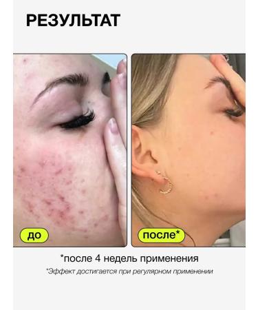 CARBON THEORY Point remedy with zinc paste from acne and acne - Buy Online on GoSupps.com