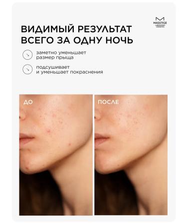 MASSTIGE Cream Seck from acne fast -acting - Buy Online on GoSupps.com