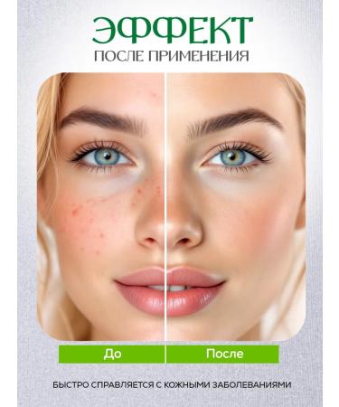 Med Enlim Chinese miracle ointment from psoriasis dermatitis acne 2pcs - Buy Online on GoSupps.com