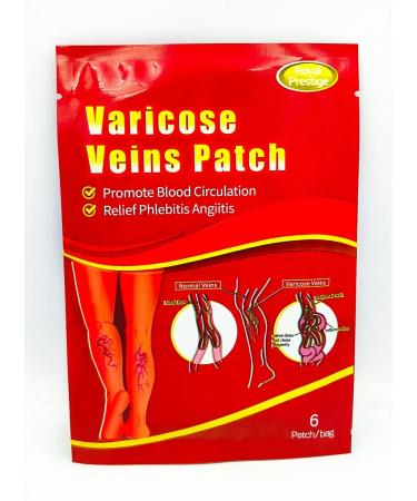 varicose veins Original. Plasticity from varicose expansion