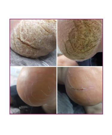 Rosilak Cream mask for the skin of the legs of nails and cutouts - Buy Online on GoSupps.com