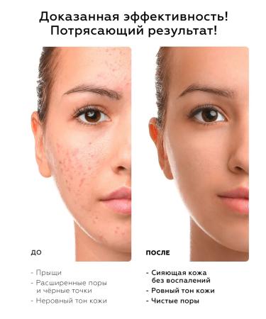 BIOBALANCE Facial serum against acne - Buy Online on GoSupps.com
