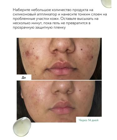 ERBORIAN Acne gel and acne on the face healing 9 ml - Buy Online on GoSupps.com