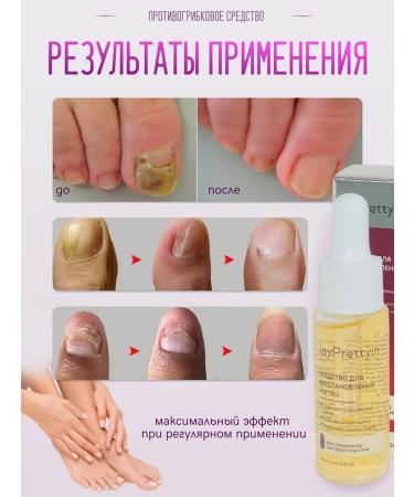 JoyPrettyin Remedy for nail fungus on the legs and arms of a drop butter - Buy Online on GoSupps.com