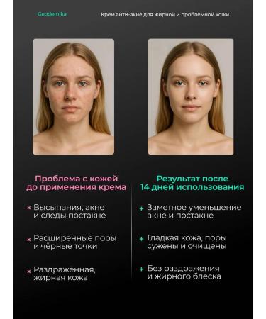 Geodemics Cream for acne zinc and niacinamide 50ml - Buy Online on GoSupps.com