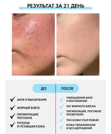 DOLL Beauty Facial serum from acne and acne - Buy Online on GoSupps.com