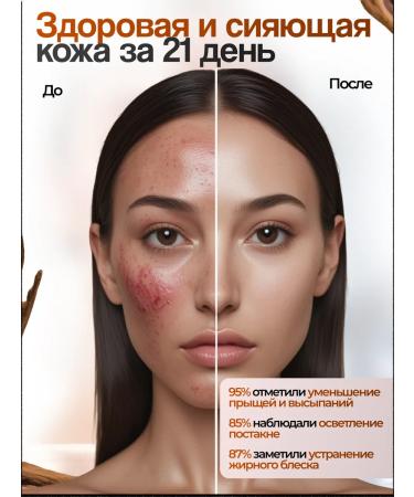 OIL'I Acne and acinumine acne whey - Buy Online on GoSupps.com