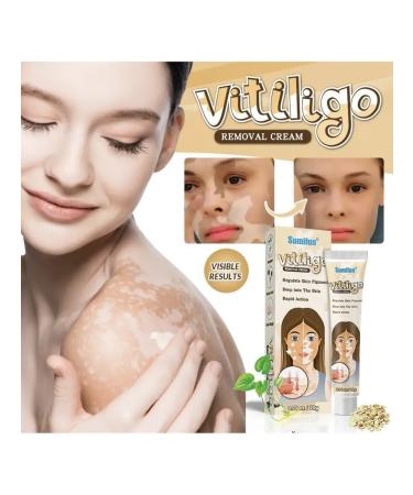 GChe Cream against the pigmentation of the skin of vitiligo white spots - Buy Online on GoSupps.com