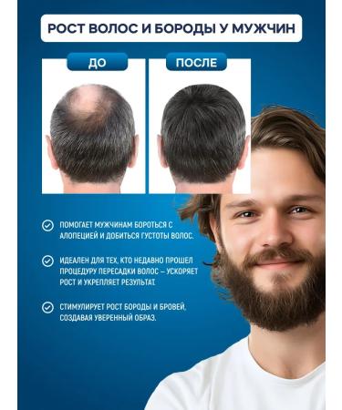 minox-boost The same 5% (3pcs) for hair growth and beard - Buy Online on GoSupps.com