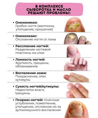 Queen of Oils Serum and oil against the onycholysis of the nail fungus - Buy Online on GoSupps.com