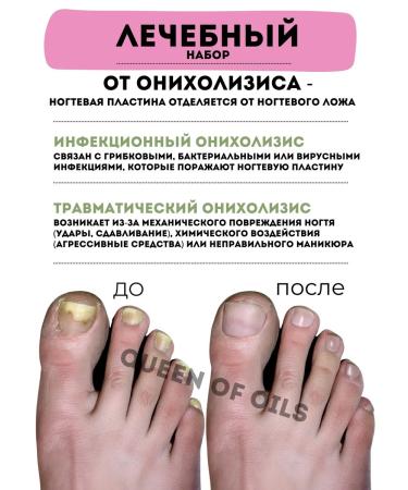 Queen of Oils Serum and oil against the onycholysis of the nail fungus - Buy Online on GoSupps.com