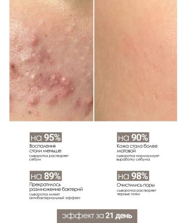 The Virgin Beauty Facial and body serum against acne from acne - Buy Online on GoSupps.com