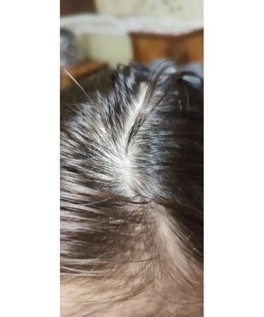 FOR HAIR Anti-hair loss remedy - Buy Online on GoSupps.com