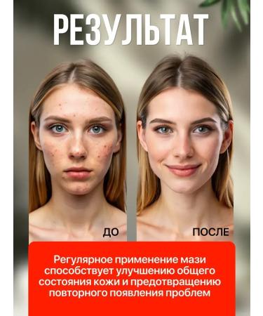 Skin King Cream Ointment from acne and psoriasis - Buy Online on GoSupps.com