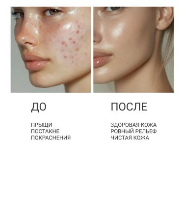 SATIVA Remedy against acne No. 35 point from acne acne - Buy Online on GoSupps.com