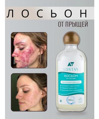 LOSTAY Acne and inflammation on the face with niacinamide