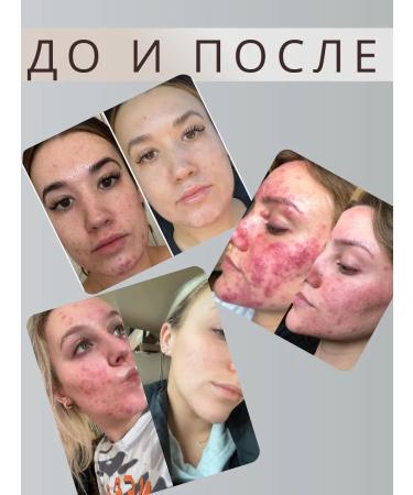 LOSTAY Acne and inflammation on the face with niacinamide - Buy Online on GoSupps.com