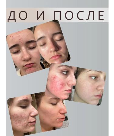 LOSTAY Acne and inflammation on the face with niacinamide - Buy Online on GoSupps.com