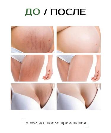 SheKerma Stretching cream moisturizer milk - Buy Online on GoSupps.com