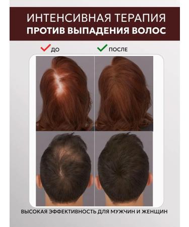 Vitex Balm against hair loss Pro minxil - Buy Online on GoSupps.com