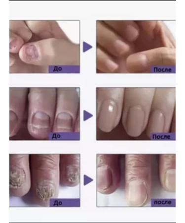 cream Chinese remedy for nail fungus 30 ml - Buy Online on GoSupps.com