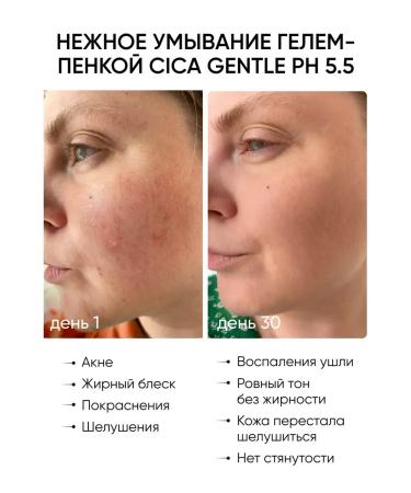 Washing gel moisturizing from acne and acne - Buy Online on GoSupps.com