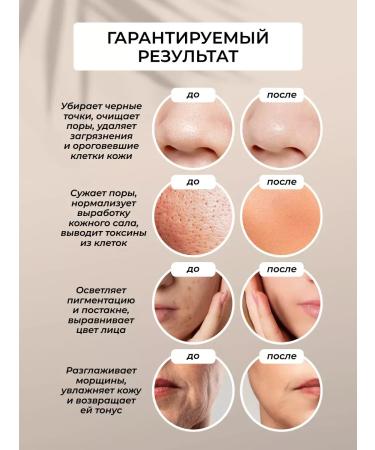 Ultrasonic facial cleaning apparatus from black dots US-1 - Buy Online on GoSupps.com