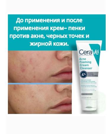 CeraVe Acne 150 ml acne washing cream - Buy Online on GoSupps.com