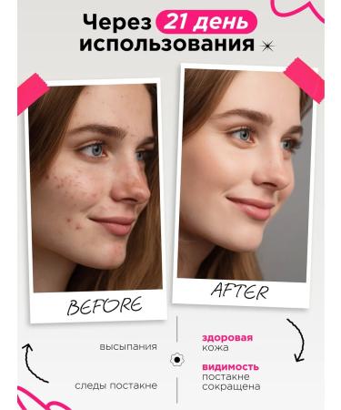 MIXIT Mask with acids for problem skin Stop Acne Face Mask - Buy Online on GoSupps.com