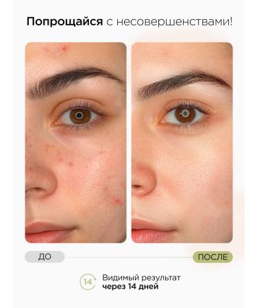 MIXIT Pads with acids for problem skin Stop Acne Face Pads - Buy Online on GoSupps.com