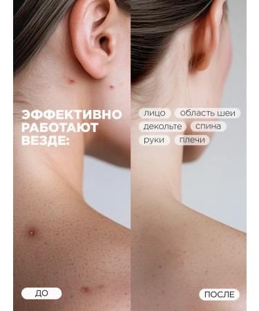 MIXIT Pads with acids for problem skin Stop Acne Face Pads - Buy Online on GoSupps.com