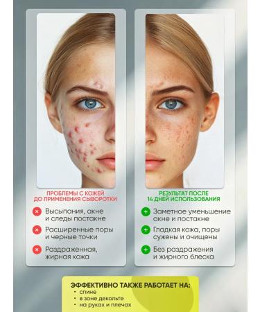 Etens l for you Facial serum from acne and black dots - Buy Online on GoSupps.com