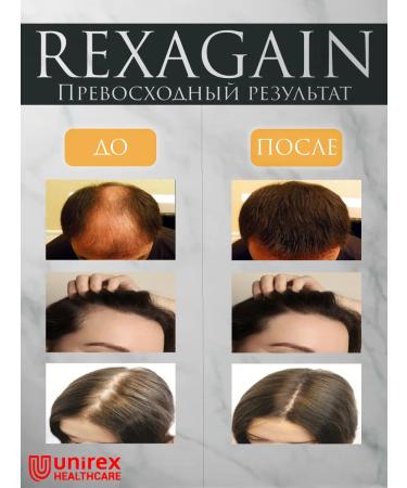 Rexagain Capixil Lotion for Capixyl hair growth 10% - Buy Online on GoSupps.com
