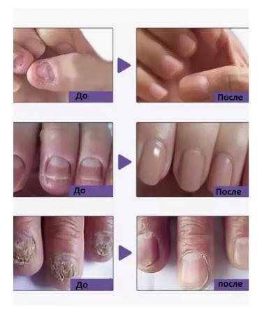 Remedy for nail fungus on the legs 2pcs cream - Buy Online on GoSupps.com