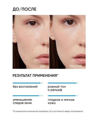 ICON SKIN Facial peeling 18% of acne and inflammation - Buy Online on GoSupps.com