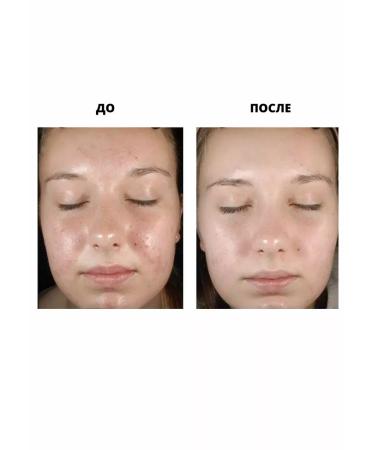 Mandelic Acid's almond acid peeling 10% +HA - Buy Online on GoSupps.com