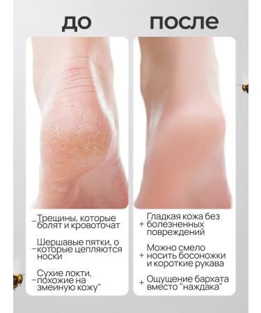 Totti Beauty Cream-wax from cracks for dry skin+ hydrocolloid patch - Buy Online on GoSupps.com